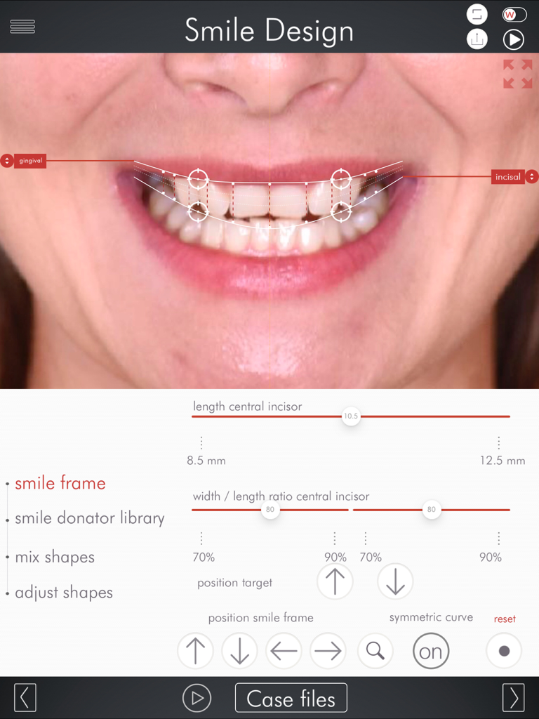DSD App - Digital Smile Design app interface showing dental measurement overlays and tooth proportion adjustments on a patient photo