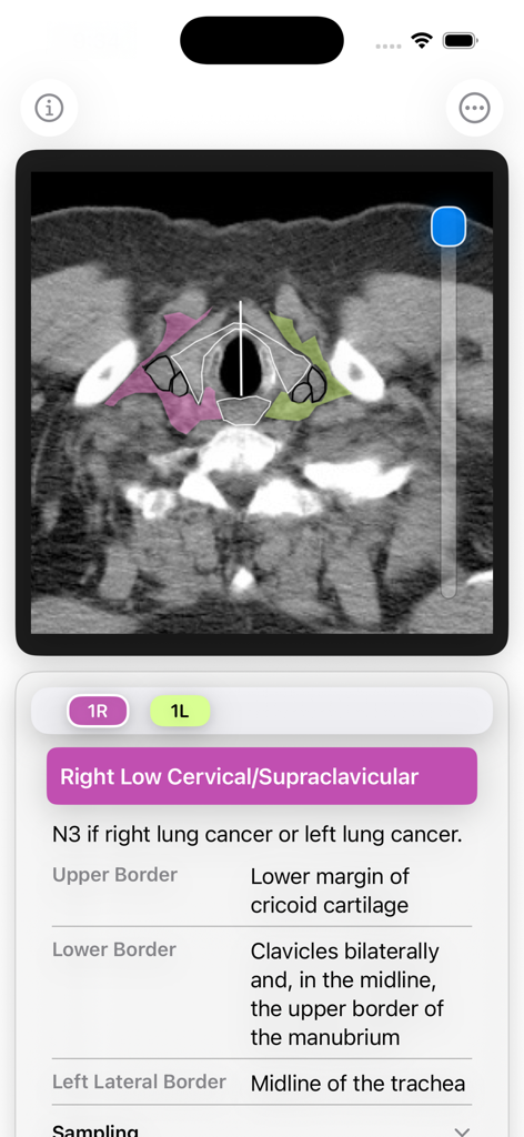 Interfaz de aplicación médica que muestra una TC torácica con superposiciones codificadas por colores de estaciones de ganglios linfáticos y definiciones de límites anatómicos.