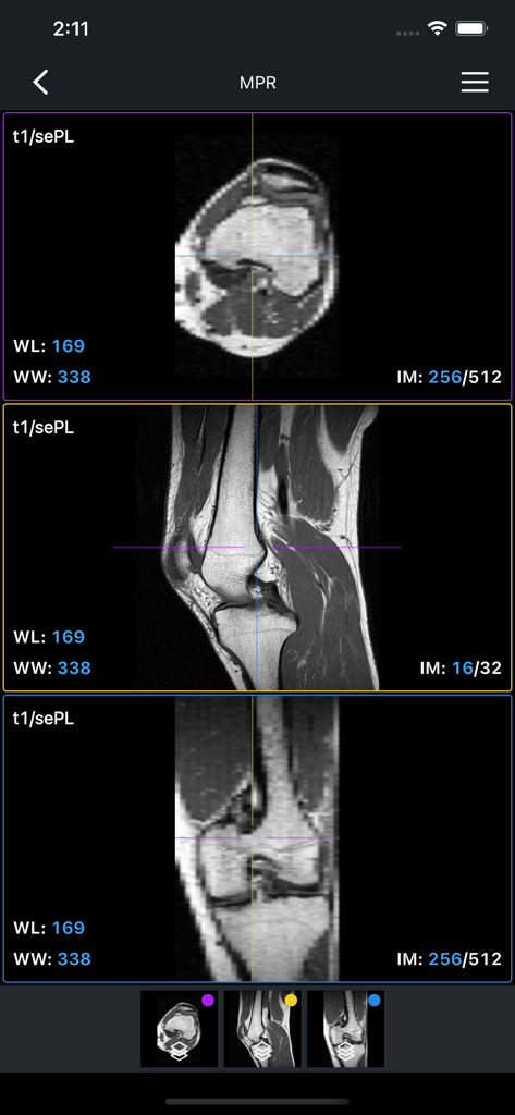 Multi-planar reconstruction of a knee MRI scan showing axial, sagittal, and coronal views on the IDV mobile app.