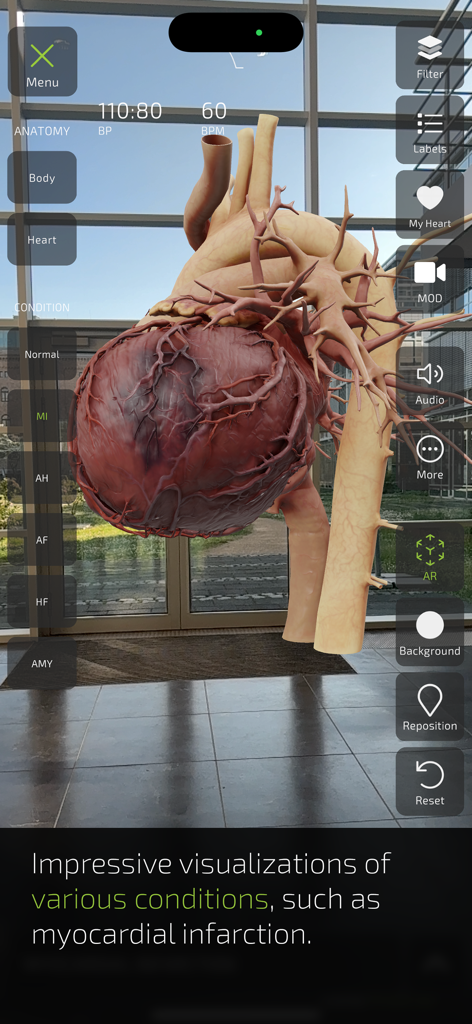 Augmented reality 3D model of a human heart showing myocardial infarction in a medical education app.