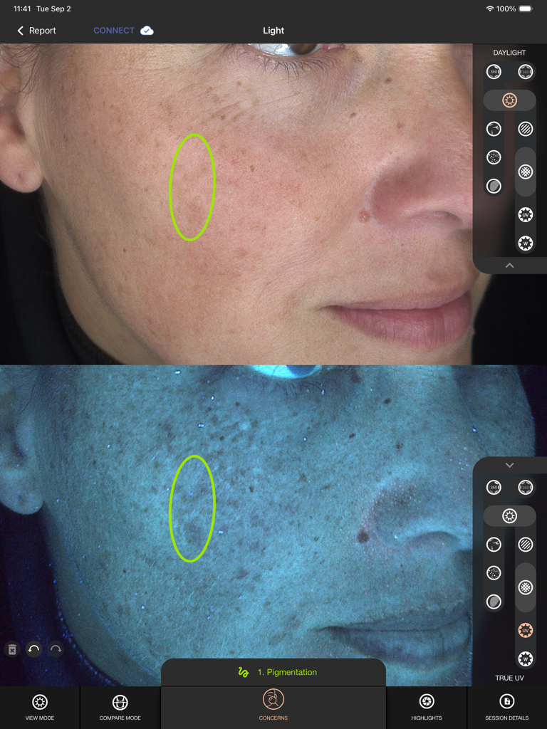 Alma IQ - Alma IQ interface comparing daylight and UV light imaging for skin pigmentation analysis.