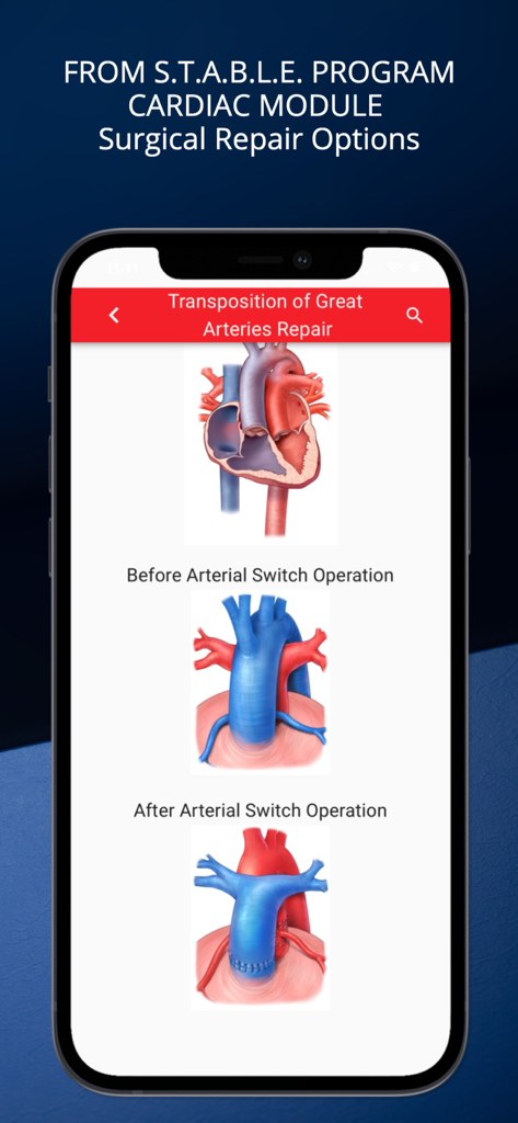 STABLEize - The STABLE Program - STABLEizeアプリのスクリーンショット、大血管転位に対する動脈スイッチ操作の前後の心臓イラストを表示