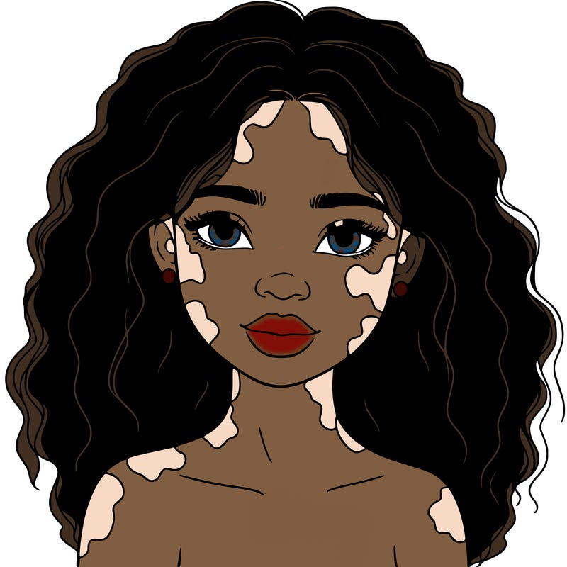 beautiful black girl with vitiligo