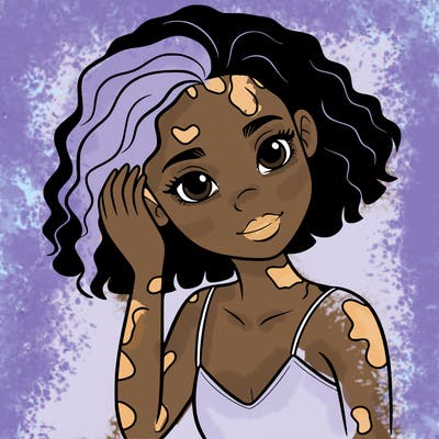 vitiligo black girl