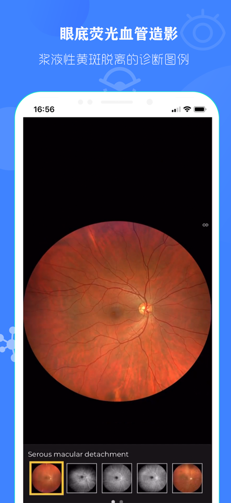 眼部解剖图 - 眼部结构精美全息科普插图 - Fundusfotografie, die einen serösen Makula-Abfall auf dem Bildschirm einer medizinischen App zeigt