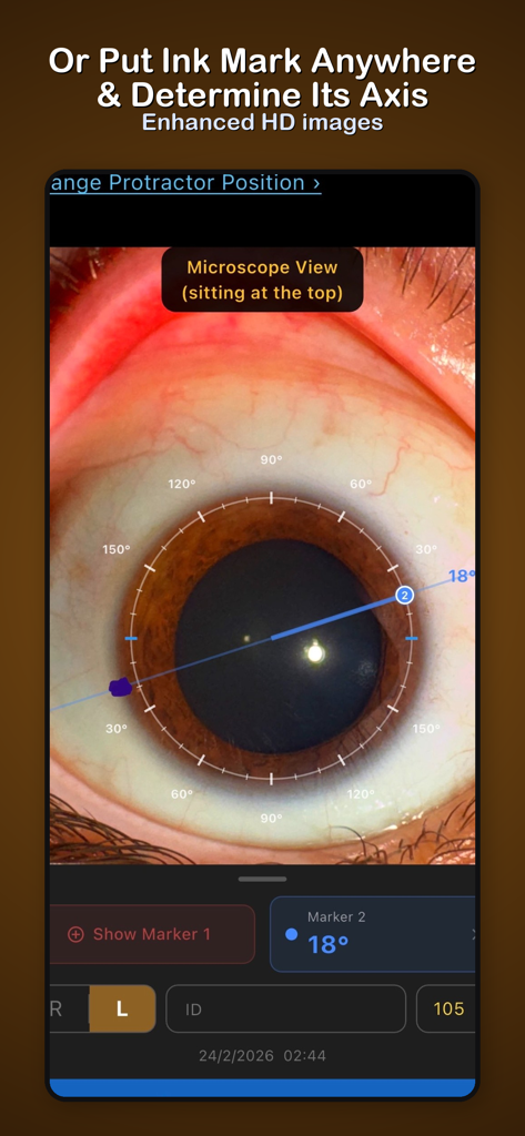 Toric IOL - Toric IOL app interface showing a digital protractor identifying the axis of an ink mark on an eye image