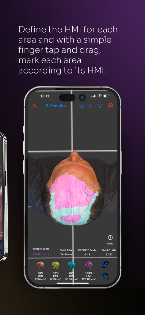 ScalpScan AI app interface displaying a 3D scalp model with Hair Mass Index mapping for hair transplant surgical planning.