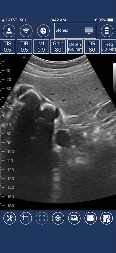 EdgeLife - Pantalla de teléfono inteligente que muestra la interfaz de la aplicación de ultrasonido EdgeLife con un escaneo de diagnóstico de cálculos y parámetros de imágenes médicas