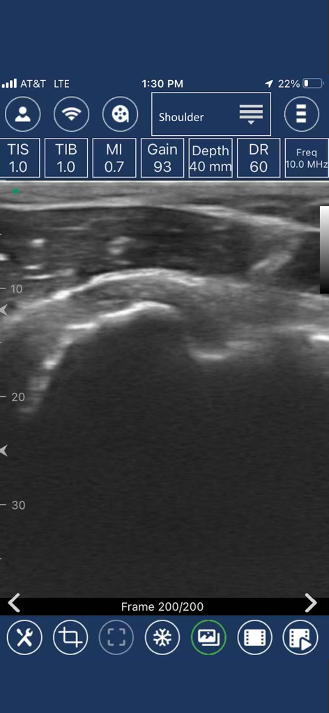 EdgeLife - Interfaz de la aplicación móvil EdgeLife que muestra un escaneo profesional de ultrasonido de hombro