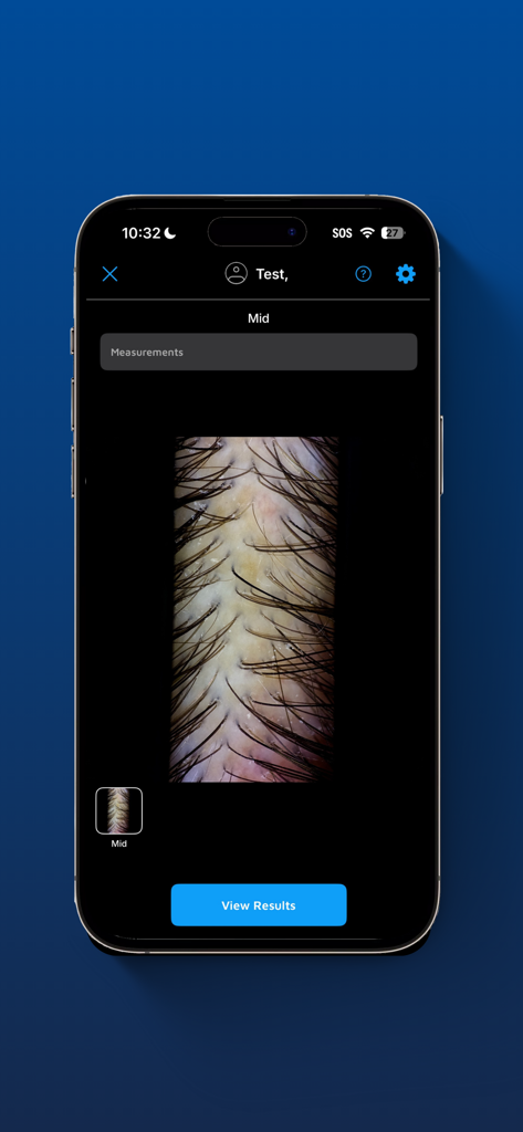High resolution scalp and hair follicle imaging for clinical analysis in the VEOS HairMetrix app