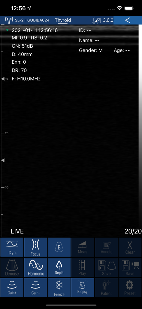 WirelessUSG Flash - WirelessUSG Flash mobile app interface showing a live thyroid ultrasound scan with medical control buttons