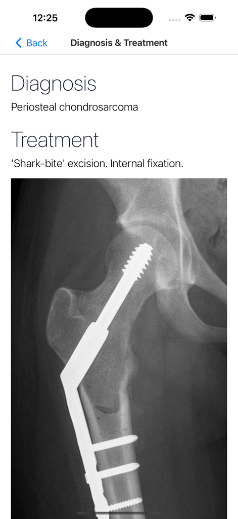 BoSTT - BoSTT app screenshot showing a diagnosis of Periosteal chondrosarcoma and an X-ray of internal fixation treatment.
