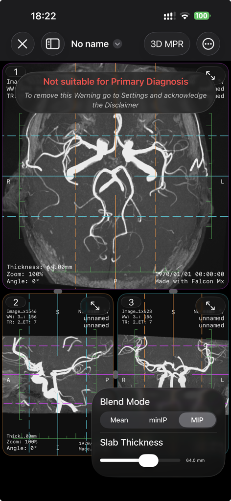 Falcon Mx - Falcon Mx interface showing 3D Multi-Planar Reconstruction and MIP blend mode on a medical scan