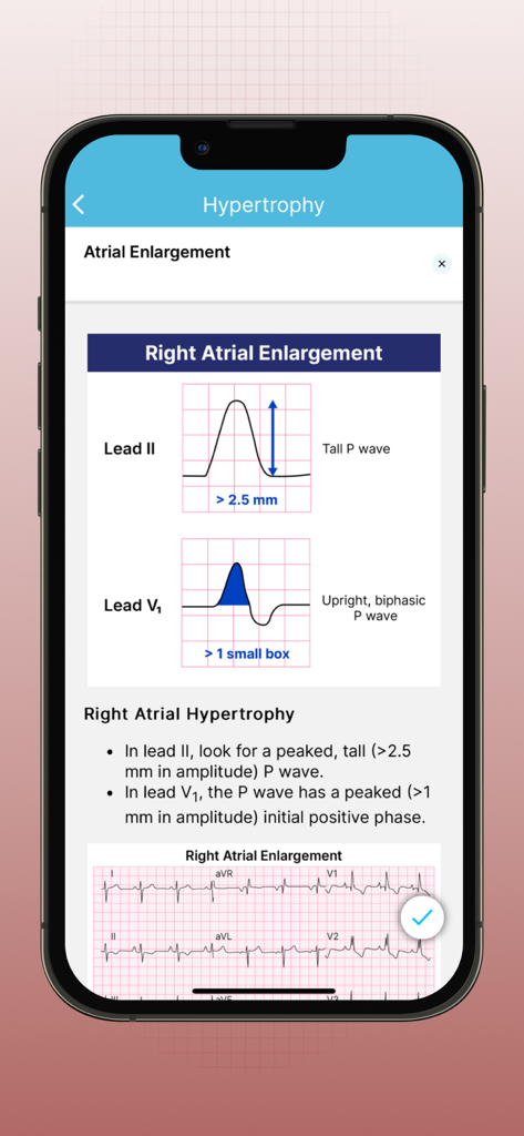 ECG EKG Interpretation Mastery - Mobile app screen explaining Right Atrial Enlargement with EKG diagrams for Lead II and V1.