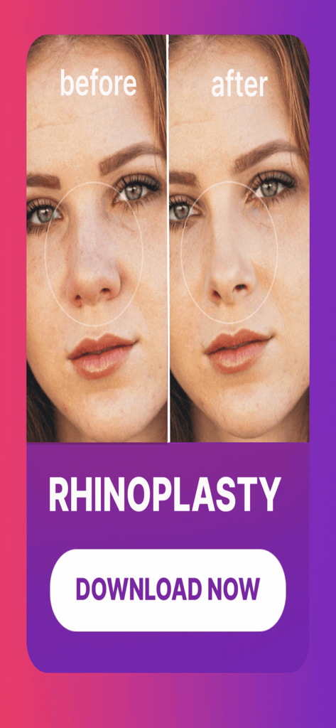 Pody Plastic Surgery Simulator - Before and after side by side comparison of a rhinoplasty nose job simulation