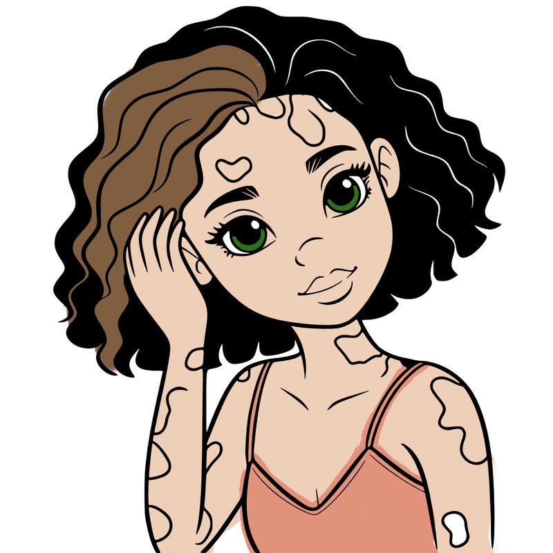 vitiligo black girl