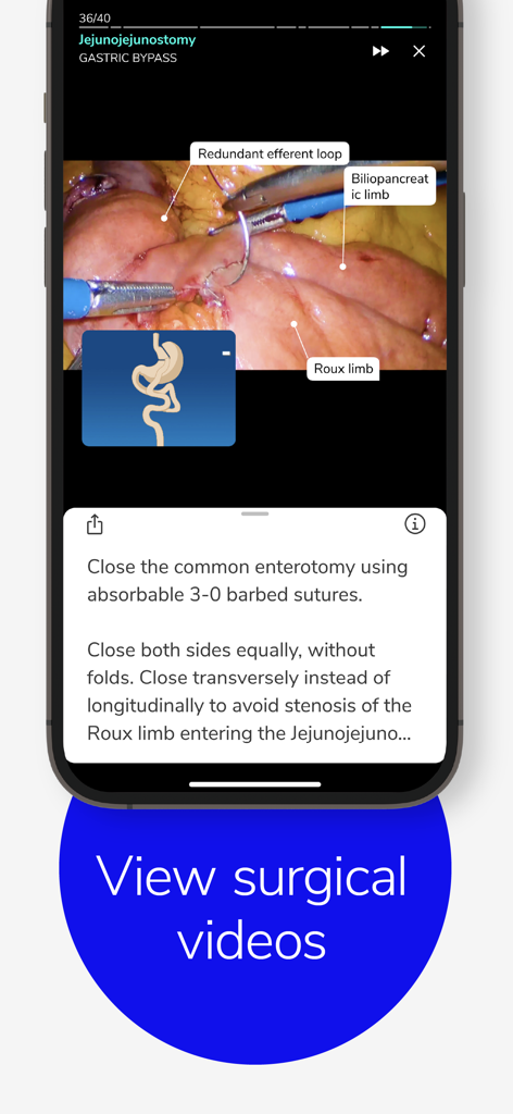 Touch Surgery: Surgical Videos - Surgical video simulation of a gastric bypass procedure in the Touch Surgery app