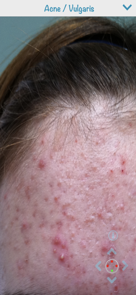 Dermatology (AIMapps) - Klinisches Foto von Akne vulgaris auf einer Stirn aus dem visuellen Atlas der Dermatologie-App