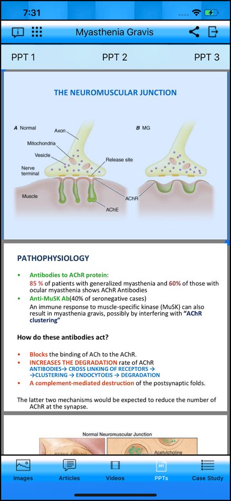 Myasthenia Gravis - Medical App | MWM