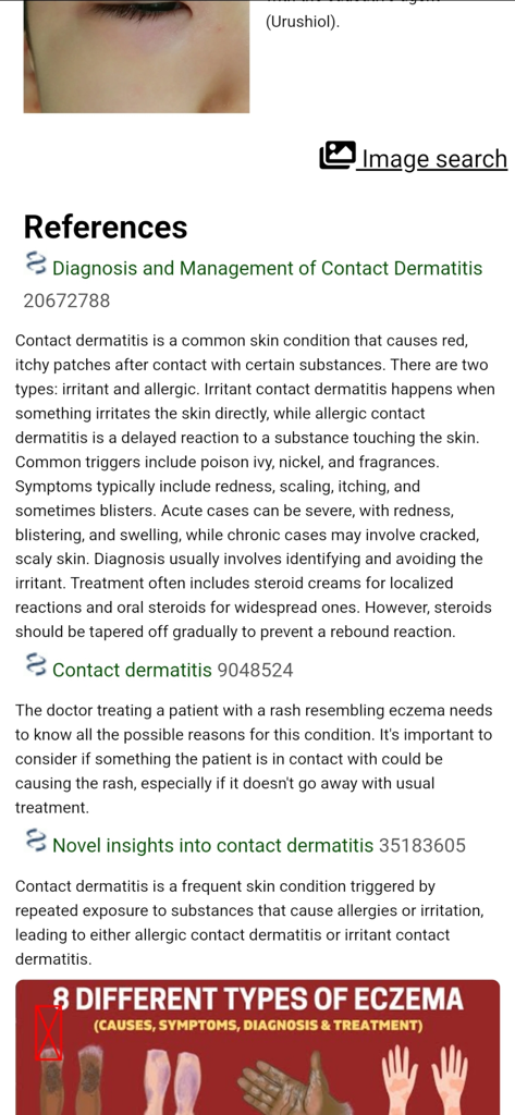 Model Dermatol - Wiki - A screenshot of the Model Dermatol Wiki app showing medical references and detailed information about contact dermatitis and eczema.