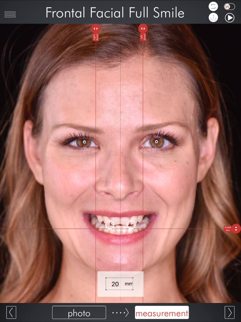 DSD App - DSD App interface showing frontal facial smile analysis with digital measurement grid lines on a patient's photo.