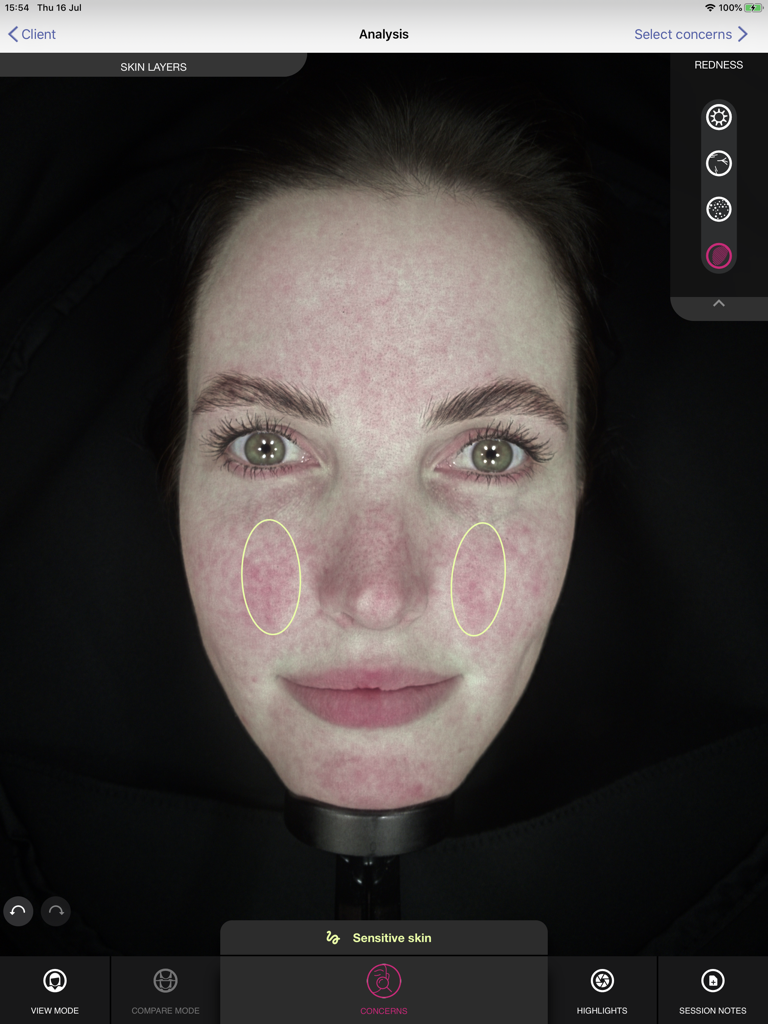 OBSERV 320 - Professional facial skin scan analysis showing redness and sensitive skin areas on the OBSERV 320 iPad application.