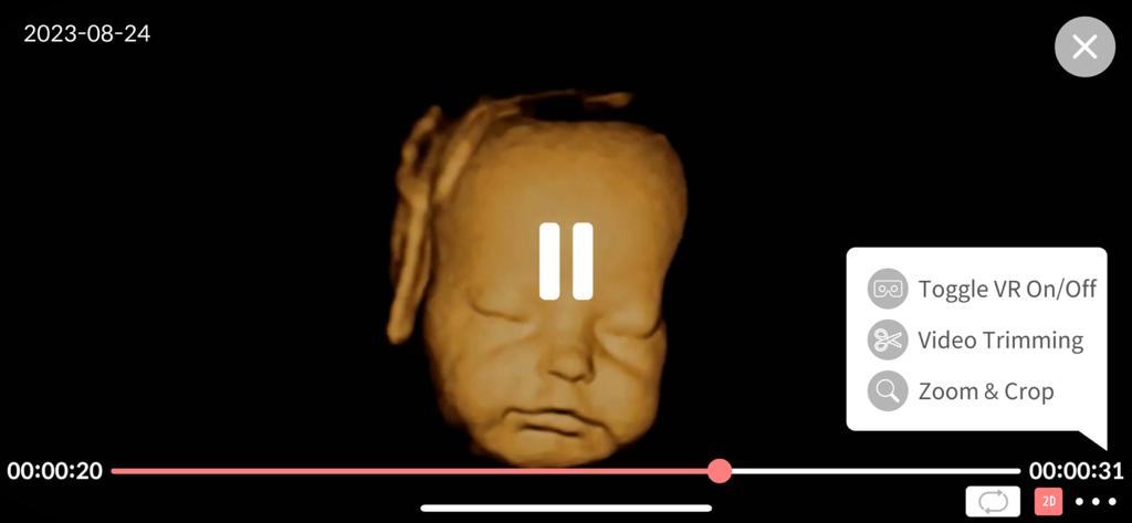 Aluvuu Fetus - A 3D ultrasound video of a fetus face showing editing options like VR mode, video trimming, and cropping.