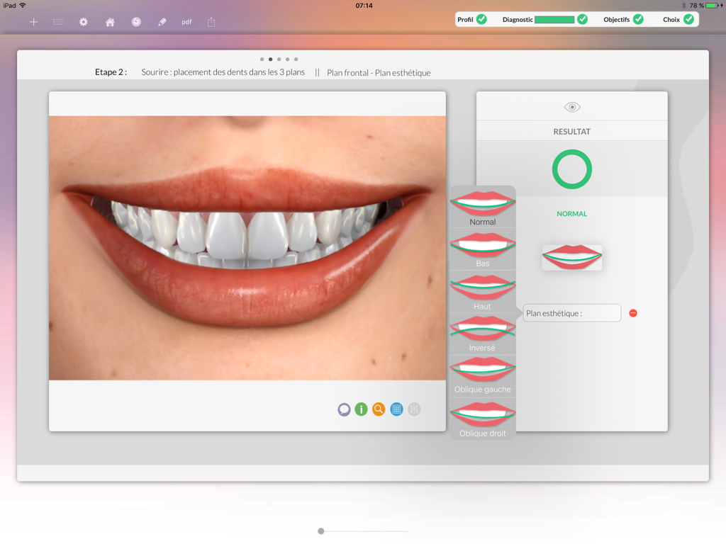 Digital smile analysis interface on an iPad for cosmetic dentistry diagnostics
