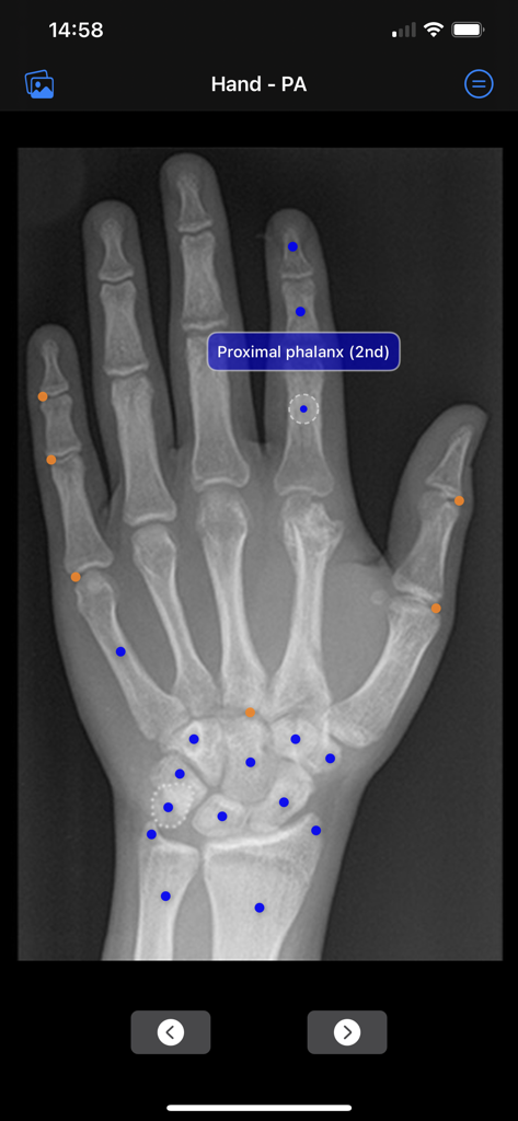 Hand PA X-ray showing anatomical markers and proximal phalanx label in the Xray Anatomy app
