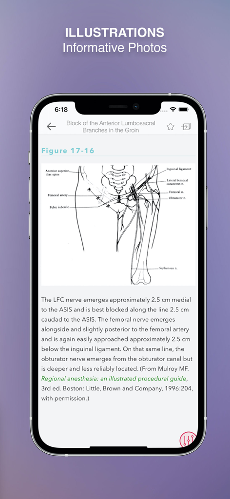 Clinical Anesthesia MGH HBK - Anatomical diagram showing the lumbosacral branches for a nerve block in the Clinical Anesthesia MGH app.