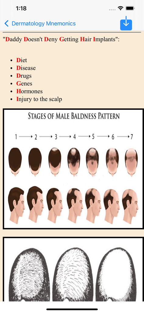 All Medical Mnemonics App - A dermatology mnemonic for causes of hair loss accompanied by a diagram showing the seven stages of male pattern baldness.