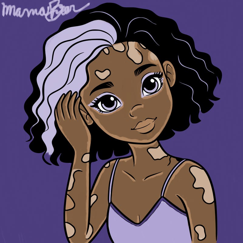 vitiligo black girl