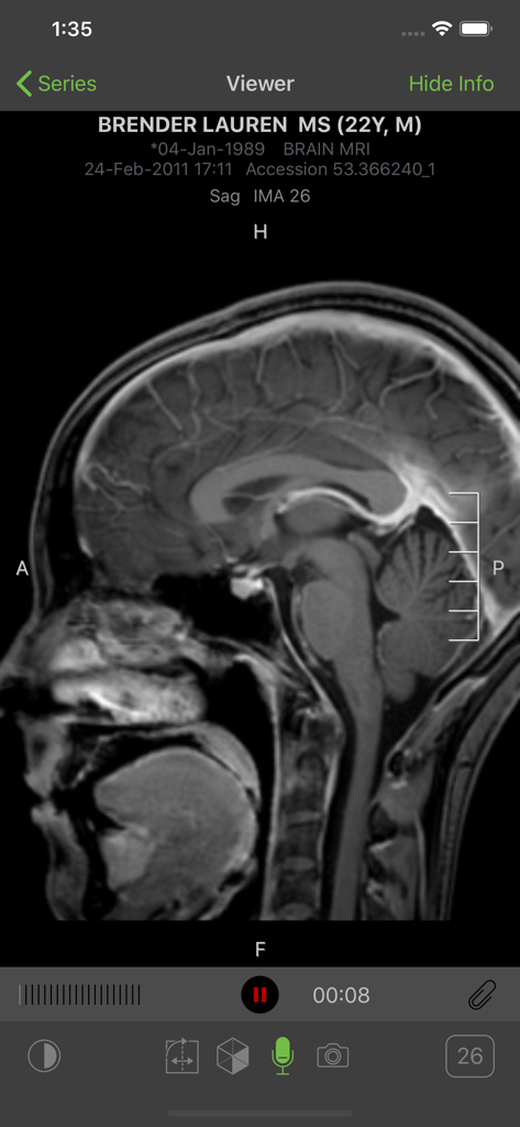 Visage Ease - Sagittal brain MRI scan displayed on the Visage Ease mobile application interface.