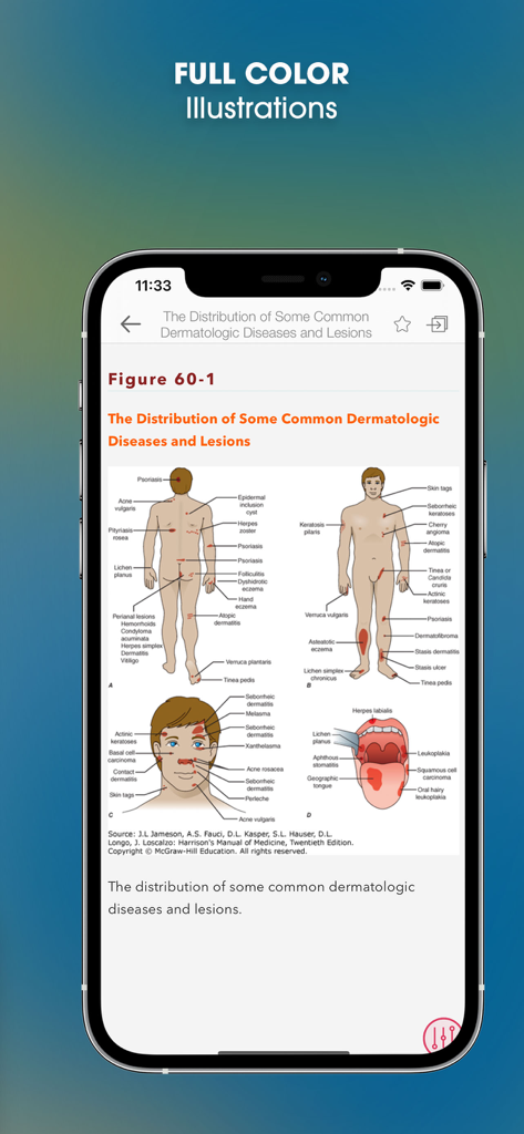 A medical illustration within the Harrison's Manual of Medicine app showing the anatomical distribution of common dermatologic diseases and lesions on a human body diagram.