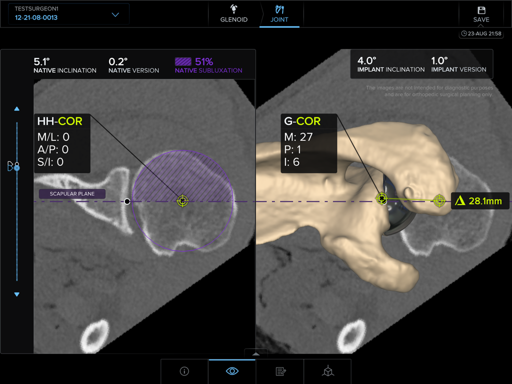 Preoperative planning dashboard in ArthrexVIP showing 2D and 3D shoulder implant metrics