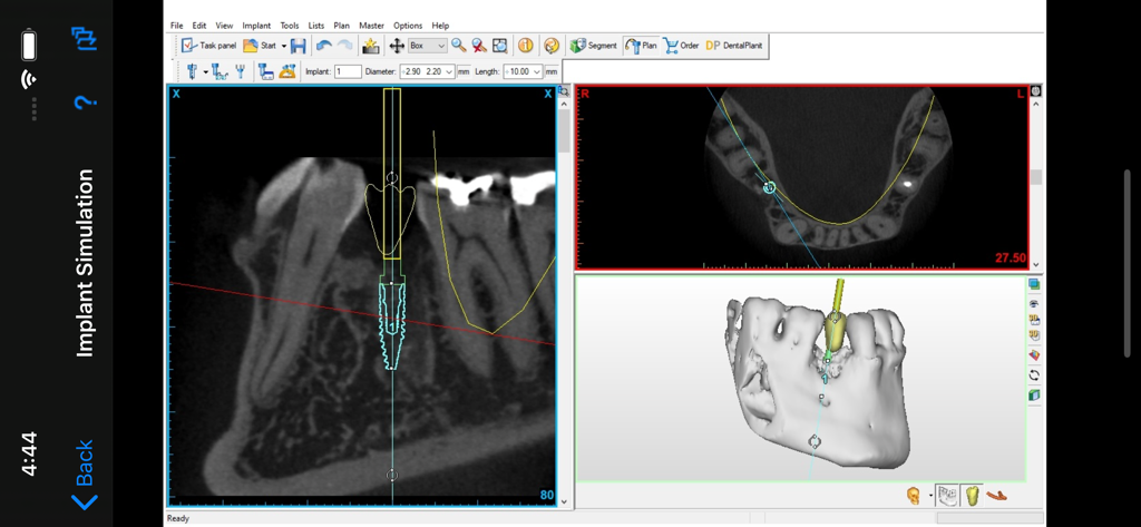 Dental CT View - Dental implant simulation showing 3D jaw model and CT cross section views