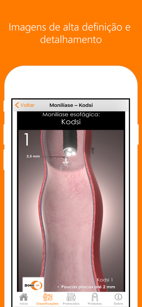 Classificações Endoscópicas - Classificacoes Endoscopicasアプリ内で、食道カンジダ症のKodsi分類の医療イラストが表示されています。