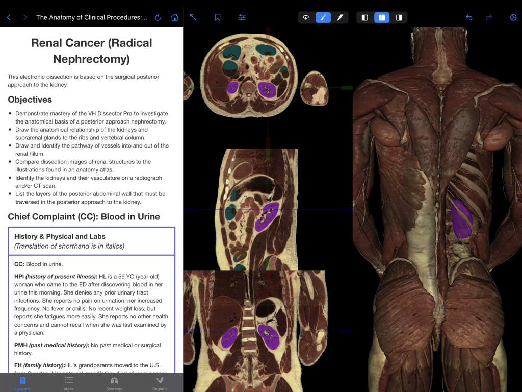 VH Dissector Pro - VH Dissector Pro interface showing a renal cancer case study with correlated 3D anatomy and cross-sectional views