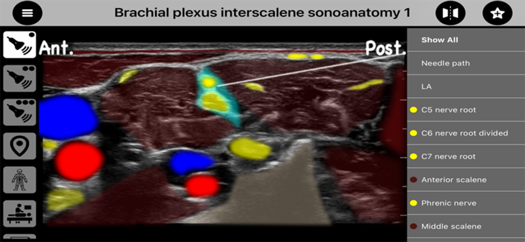 AnSo Pro - Aplicativo AnSo Pro mostrando uma imagem de ultrassom do plexo braquial interescalênico com sobreposições anatômicas codificadas por cores para raízes nervosas e músculos.