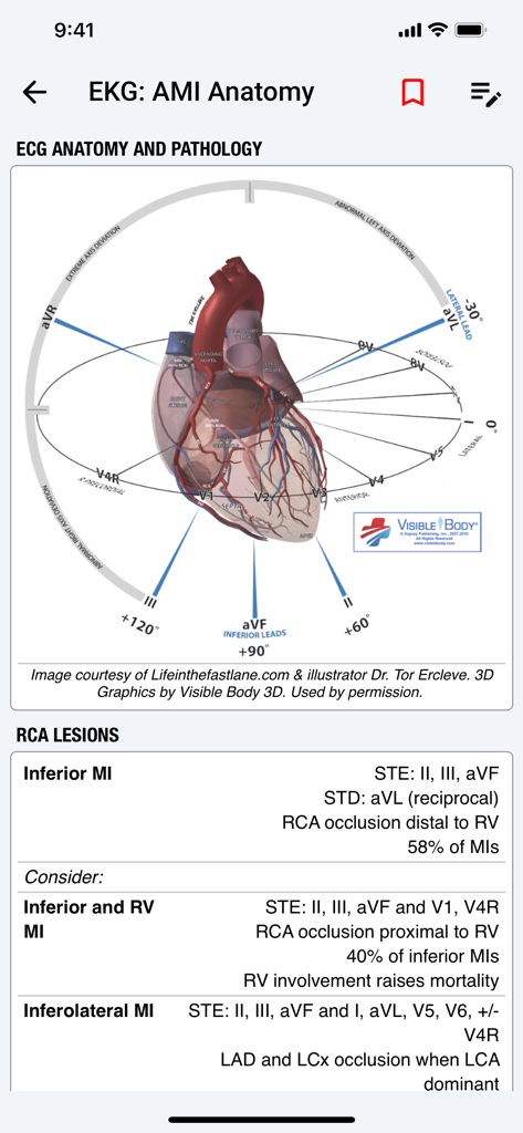 palmEM AI: EM Quick Reference - Medical app screen showing EKG anatomy and AMI pathology reference diagram