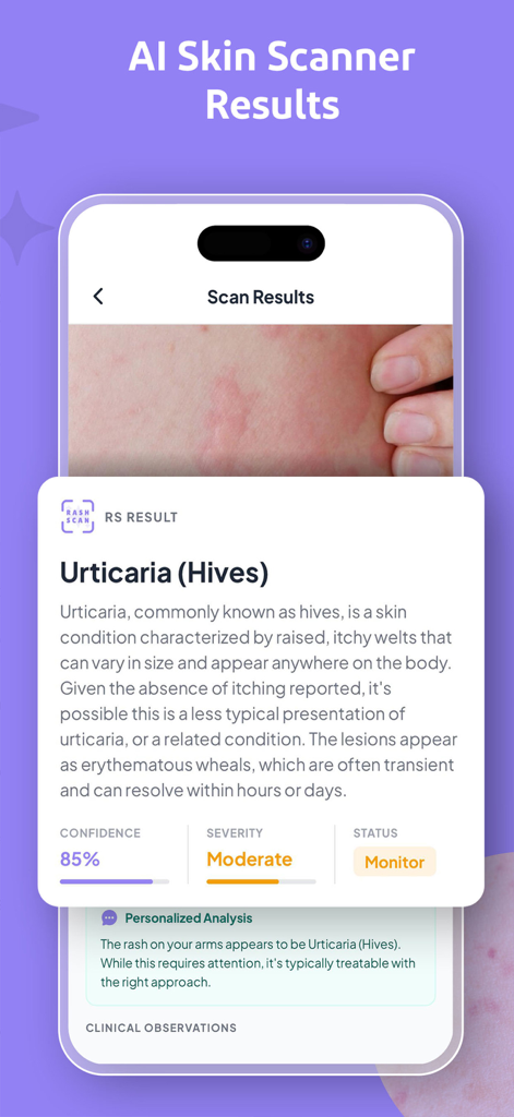Rash Scan app displaying AI skin scanner results for hives with moderate severity and 85 percent confidence.