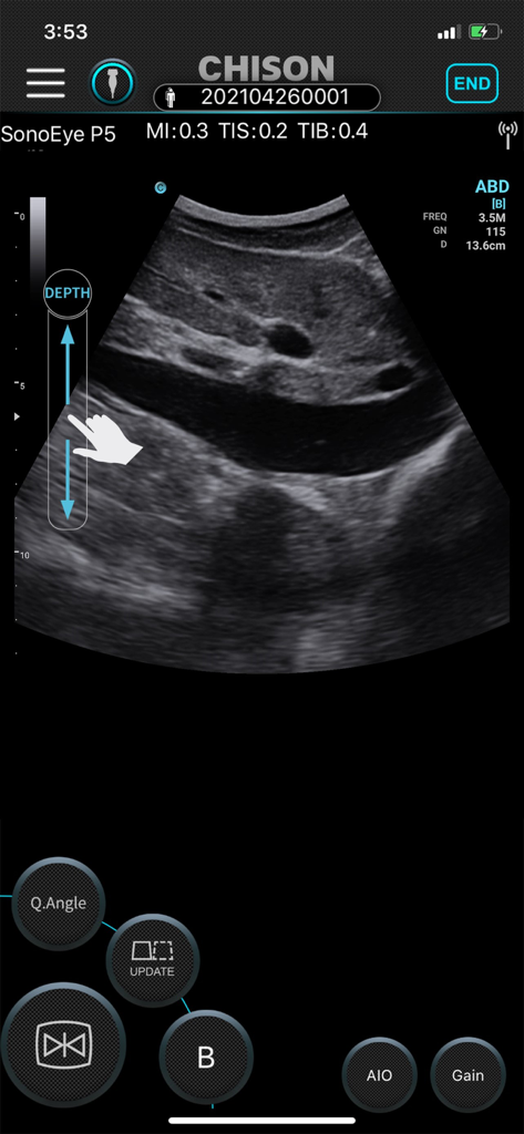 SonoEye - Interface do aplicativo SonoEye mostrando um ultrassom abdominal com controles de toque