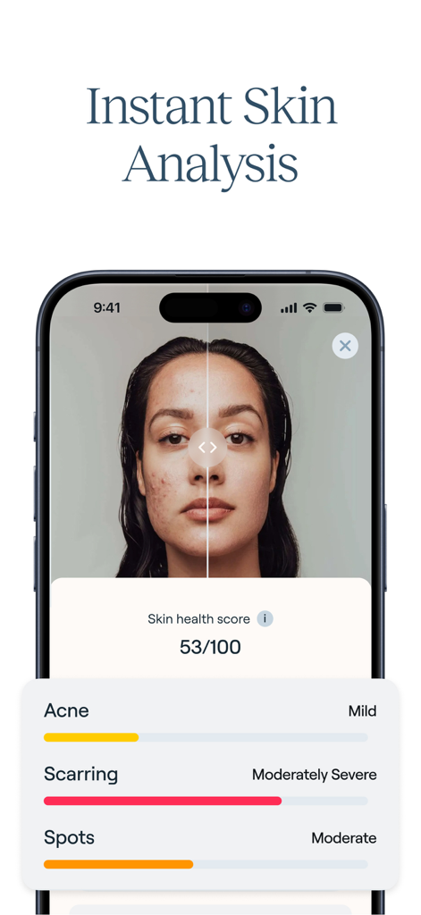 Schermata dell'app Nolla Acne che mostra l'analisi istantanea della pelle con punteggio di salute e metriche dettagliate per cicatrici da acne e brufoli