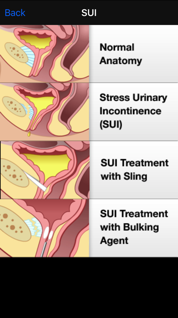 Four-panel anatomical diagram showing normal anatomy, stress urinary incontinence, and treatment options with sling and bulking agent.