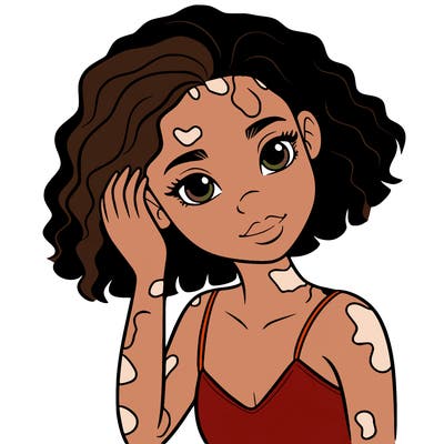 vitiligo black girl