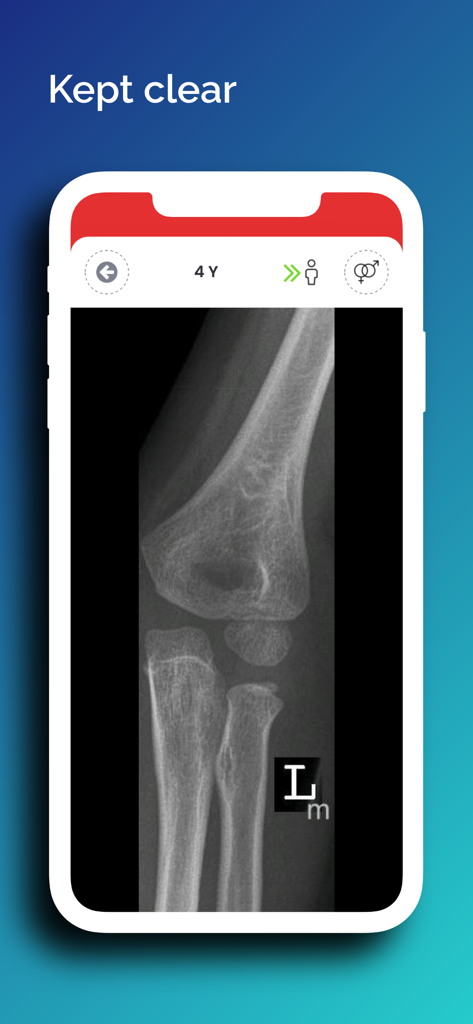 Pedbone medizinische App zeigt ein klares pädiatrisches Ellenbogenröntgenbild eines vierjährigen Patienten.