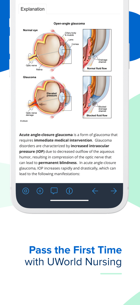 Detailed medical illustration and explanation of glaucoma in the UWorld Nursing app