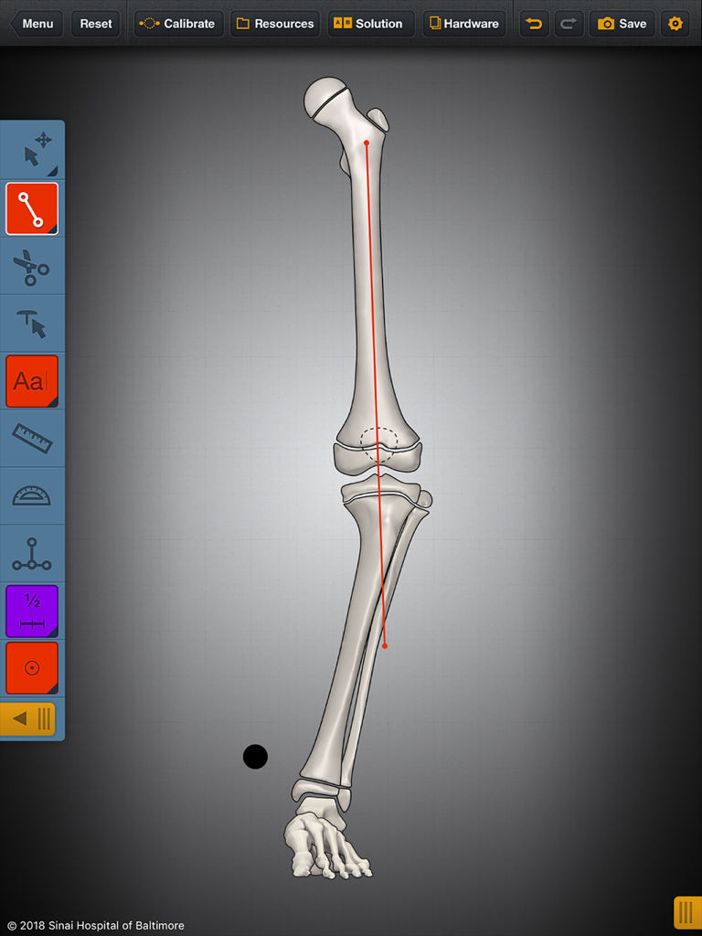 Interface of the Bone Ninja app showing a 3D model of a leg bone with a red alignment line and surgical planning tools