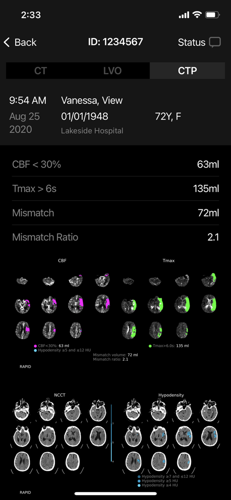 RapidAI mobile app interface displaying detailed CTP brain scan results and perfusion maps