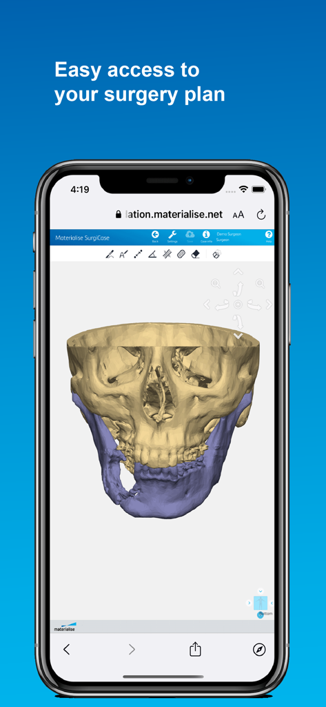 Mimics Flow - Modelo anatômico 3D de crânio para planejamento cirúrgico em um smartphone